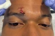 给姆总整破相了！姆巴佩晒脸部受伤近距离特写，眉骨缝了好几针